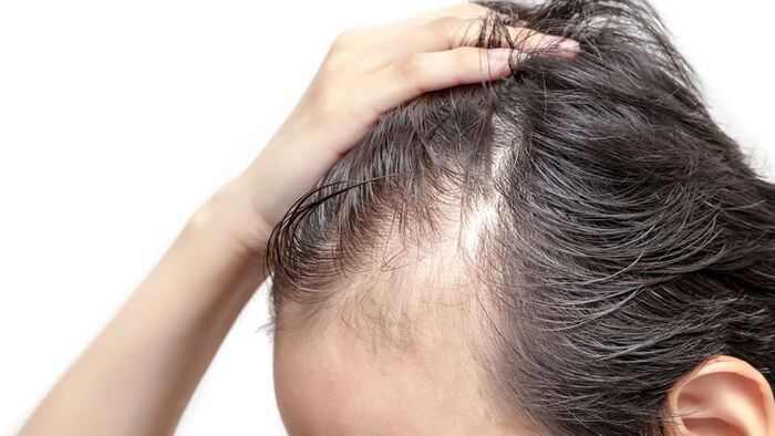 bao nhiêu tuổi thì được coi là tóc bạc sớm