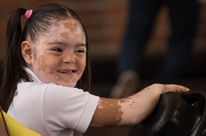bệnh bạch biến vitiligo