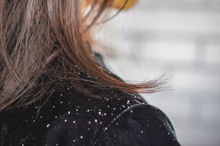 dấu hiệu nhận biết da đầu bị gàu dễ thấy