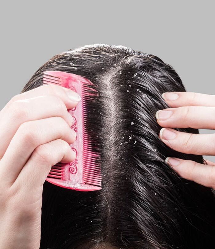 mẹo đơn giản về cách chăm sóc da đầu bị gàu áp dụng tại nhà