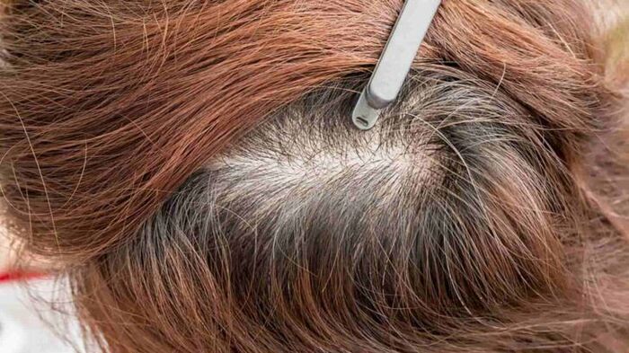 ngoài ra nhổ tóc bạc có khiến mọc tóc bạc nhiều hơn không