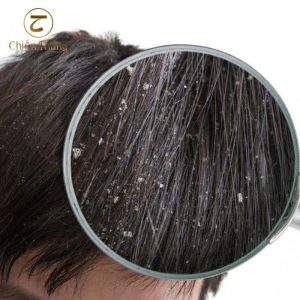 tại sao gội đầu xong vẫn có gàu