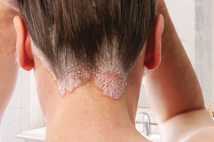 tóc bạc ngứa do bệnh lý