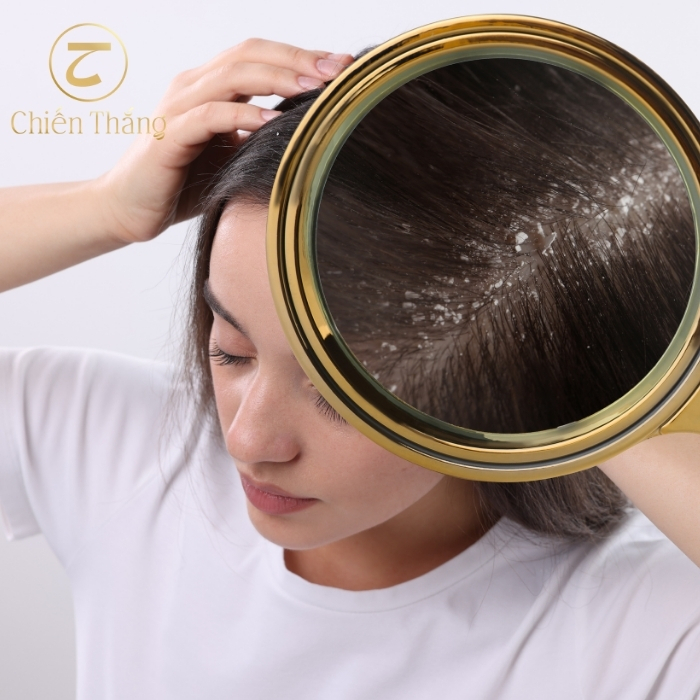 cách trị gàu cho nữ
