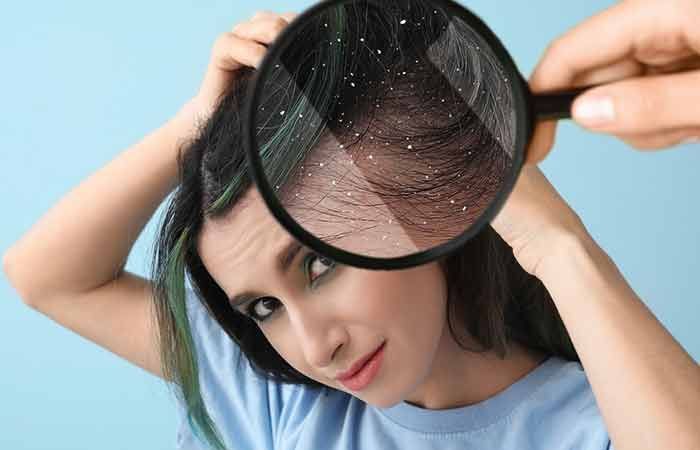 da đầu bị ngứa mùa hanh khô