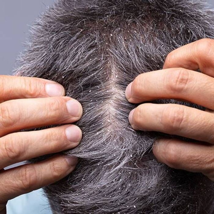 lí giải vì sao gàu mùa đông xuất hiện nhiều hơn