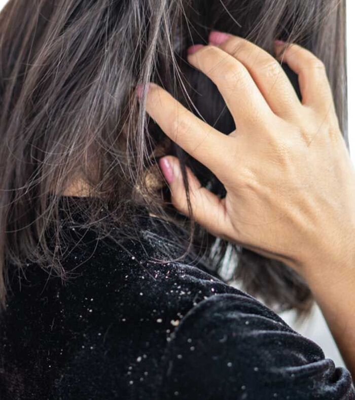 tóc bị gàu